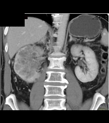 Vascular Right Renal Cell Carcinoma Invades the Renal Veins and the IVC - See Full Sequence - CTisus CT Scan