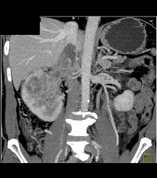 Vascular Right Renal Cell Carcinoma Invades the Renal Veins and the IVC - See Full Sequence - CTisus CT Scan