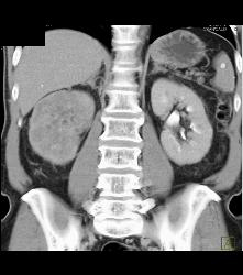 Renal Cell Carcinoma - CTisus CT Scan