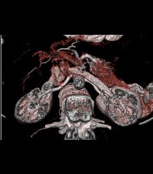 Renal Cyst - CTisus CT Scan