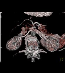 Normal Renal Artery - CTisus CT Scan