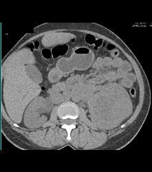 Renal Cell Carcinoma Invades the Renal Vein With Arteriovenous (AV) Shunting - CTisus CT Scan