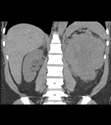 Renal Cell Carcinoma Invades the Renal Vein With Arteriovenous (AV) Shunting - CTisus CT Scan