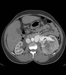 Renal Cell Carcinoma Invades the Renal Vein With Arteriovenous (AV) Shunting - CTisus CT Scan