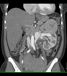 Renal Cell Carcinoma Invades the Renal Vein With Arteriovenous (AV) Shunting - CTisus CT Scan