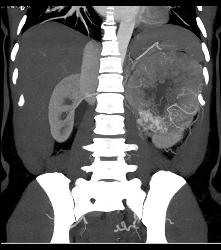 Renal Cell Carcinoma Invades the Renal Vein With Arteriovenous (AV) Shunting - CTisus CT Scan