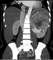 Renal Cell Carcinoma Invades the Renal Vein With Arteriovenous (AV) Shunting - CTisus CT Scan