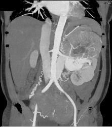 Renal Cell Carcinoma Invades the Renal Vein With Arteriovenous (AV) Shunting - CTisus CT Scan