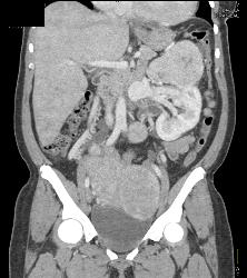 Renal Cell Carcinoma Invades the Renal Vein With Arteriovenous (AV) Shunting - CTisus CT Scan