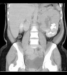 Renal Cell Carcinoma Invades the Renal Vein With Arteriovenous (AV) Shunting - CTisus CT Scan