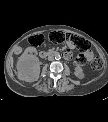 Renal Cell Carcinoma Invades the Right Renal Vein and IVC- See Full Sequence - CTisus CT Scan