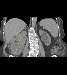 Renal Cell Carcinoma Invades the Right Renal Vein and IVC - See Full Sequence - CTisus CT Scan