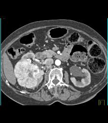 Renal Cell Carcinoma Invades the Right Renal Vein and IVC - See Full Sequence - CTisus CT Scan