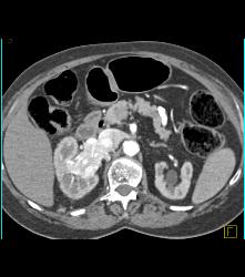 Renal Cell Carcinoma Invades the Right Renal Vein and IVC - See Full Sequence - CTisus CT Scan