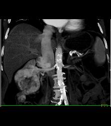 Renal Cell Carcinoma Invades the Right Renal Vein and IVC - See Full Sequence - CTisus CT Scan