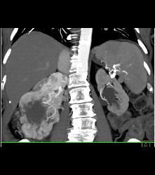 Renal Cell Carcinoma Invades the Right Renal Vein and IVC - See Full Sequence - CTisus CT Scan