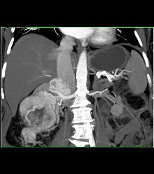 Renal Cell Carcinoma Invades the Right Renal Vein and IVC - See Full Sequence - CTisus CT Scan