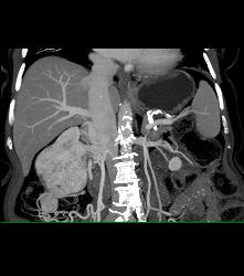 Renal Cell Carcinoma Invades the Right Renal Vein and IVC - See Full Sequence - CTisus CT Scan