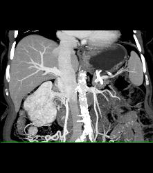 Renal Cell Carcinoma Invades the Right Renal Vein and IVC - See Full Sequence - CTisus CT Scan