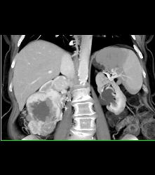 Renal Cell Carcinoma Invades the Right Renal Vein and IVC - See Full Sequence - CTisus CT Scan