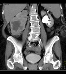 Renal Cell Carcinoma Invades the Right Renal Vein and IVC - See Full Sequence - CTisus CT Scan