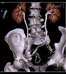 CT Urogram and Ileal Loop - CTisus CT Scan