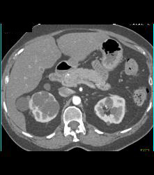 Multiple Cysts With Cystic Renal Cell Carcinoma in the Right Kidney - CTisus CT Scan