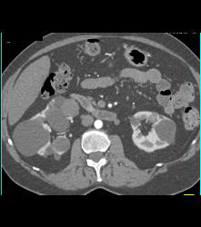 Multiple Cysts With Cystic Renal Cell Carcinoma in the Right Kidney - CTisus CT Scan