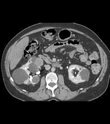 Multiple Cysts With Cystic Renal Cell Carcinoma in the Right Kidney - CTisus CT Scan