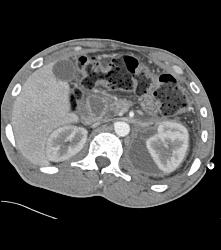 Perirenal Hematoma - CTisus CT Scan