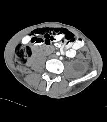 Perirenal Hematoma - CTisus CT Scan