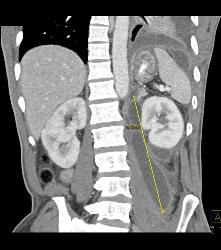 Perirenal Hematoma - Kidney Case Studies - CTisus CT Scanning