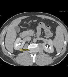 High Density 1cm Right Renal Cyst - CTisus CT Scan