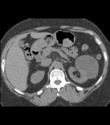 Cystic Nephroma Vs. Cystic Left Renal Cell Carcinoma- See Full Sequence of Images- the Final Diagnosis Was A Cystic Nephroma - CTisus CT Scan