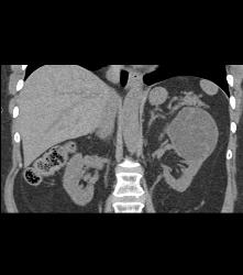 Cystic Nephroma Vs. Cystic Left Renal Cell Carcinoma- See Full Sequence of Images- the Final Diagnosis Was A Cystic Nephroma - CTisus CT Scan