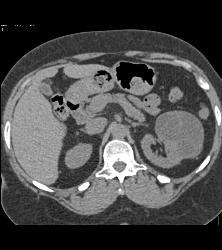 Cystic Nephroma Vs. Cystic Left Renal Cell Carcinoma- See Full Sequence of Images- the Final Diagnosis Was A Cystic Nephroma - CTisus CT Scan