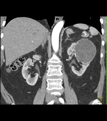 Cystic Nephroma Vs. Cystic Left Renal Cell Carcinoma- See Full Sequence of Images- the Final Diagnosis Was A Cystic Nephroma - CTisus CT Scan