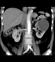 Cystic Nephroma Vs. Cystic Left Renal Cell Carcinoma- See Full Sequence of Images- the Final Diagnosis Was A Cystic Nephroma - CTisus CT Scan