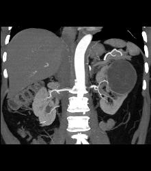 Cystic Nephroma Vs. Cystic Left Renal Cell Carcinoma- See Full Sequence of Images- the Final Diagnosis Was A Cystic Nephroma - CTisus CT Scan