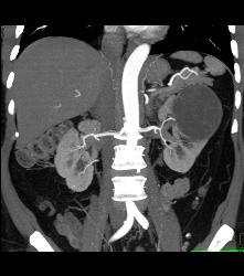 Cystic Nephroma Vs. Cystic Left Renal Cell Carcinoma- See Full Sequence of Images- the Final Diagnosis Was A Cystic Nephroma - CTisus CT Scan