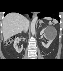 Cystic Nephroma Vs. Cystic Left Renal Cell Carcinoma- See Full Sequence of Images- the Final Diagnosis Was A Cystic Nephroma - CTisus CT Scan