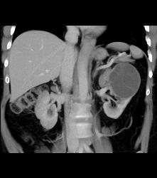 Cystic Nephroma Vs. Cystic Left Renal Cell Carcinoma- See Full Sequence of Images- the Final Diagnosis Was A Cystic Nephroma - CTisus CT Scan