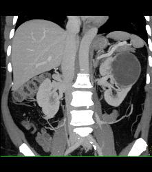 Cystic Nephroma Vs. Cystic Left Renal Cell Carcinoma- See Full Sequence of Images- the Final Diagnosis Was A Cystic Nephroma - CTisus CT Scan