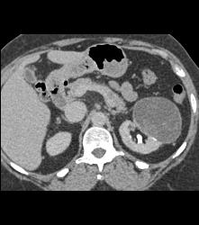 Cystic Nephroma Vs. Cystic Left Renal Cell Carcinoma- See Full Sequence of Images- the Final Diagnosis Was A Cystic Nephroma - CTisus CT Scan