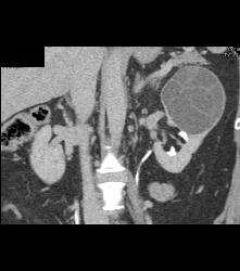 Cystic Nephroma Vs. Cystic Left Renal Cell Carcinoma- See Full Sequence of Images- the Final Diagnosis Was A Cystic Nephroma - CTisus CT Scan