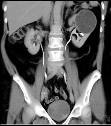 Cystic Nephroma Vs. Cystic Left Renal Cell Carcinoma- See Full Sequence of Images- the Final Diagnosis Was A Cystic Nephroma - CTisus CT Scan