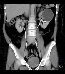 Cystic Nephroma Vs. Cystic Left Renal Cell Carcinoma- See Full Sequence of Images- the Final Diagnosis Was A Cystic Nephroma - CTisus CT Scan