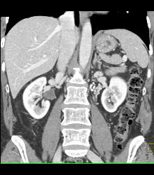 Varices Near Left Renal Hilum - CTisus CT Scan