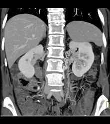 Collaterals Near Left Renal Hilum - CTisus CT Scan