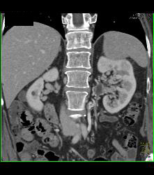 Collaterals Near Left Renal Hilum - CTisus CT Scan